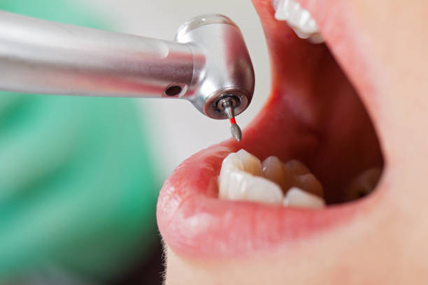 Best Dental Abscess Treatment in Yuipa, CA